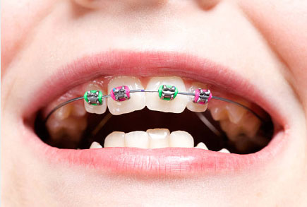 箍牙治療的類型