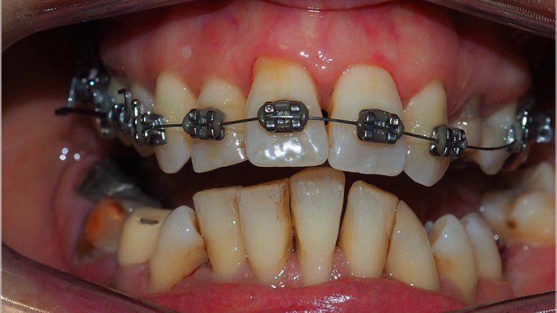 箍牙治療的重要方面